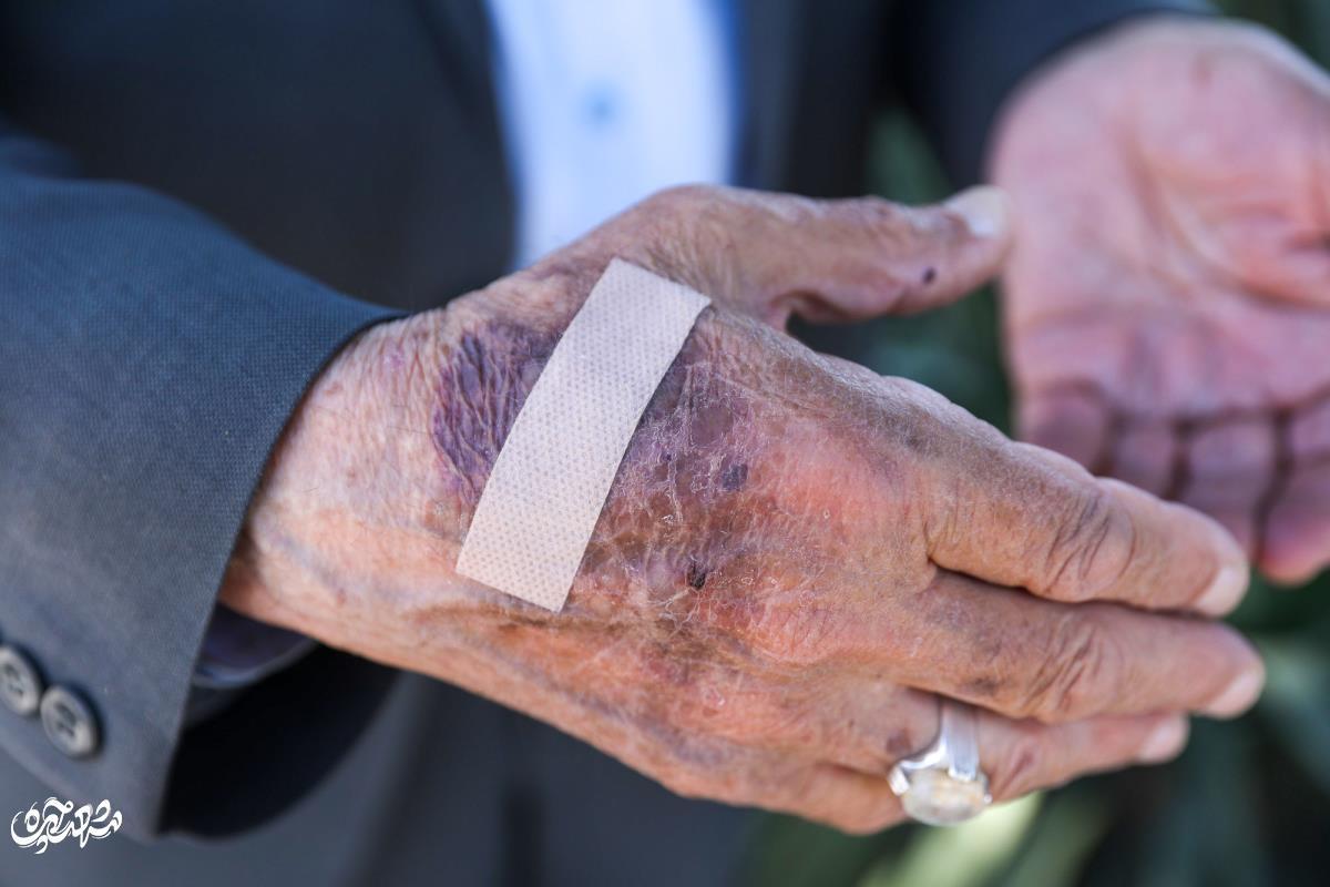 محمود دُرانی؛ پدر درختکاری مهشد که به تنهایی یک میلیون درخت کاشته است و هر روز با آنها حرف زند! دست های زخمی محمود دُرانی