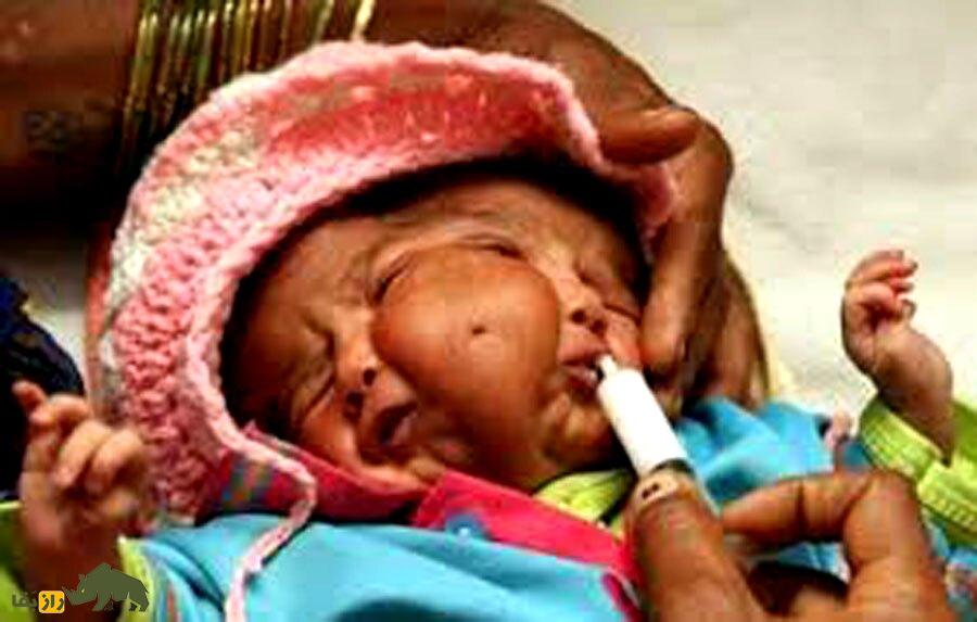 (تصاویر) تولد نوزادی با چهار چشم و دو دماغ و یک ناف در وسط صورت!