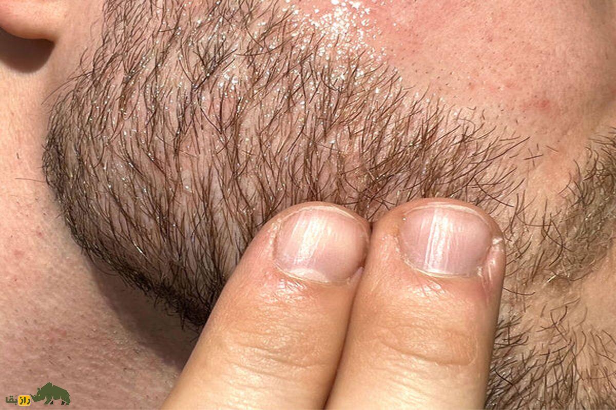 چرا بعضی نقاط بدن مانند زیر بغل و ناحیه تناسلی به صورت نقطهای همچنان مو دارند؟ ریش و انگشت