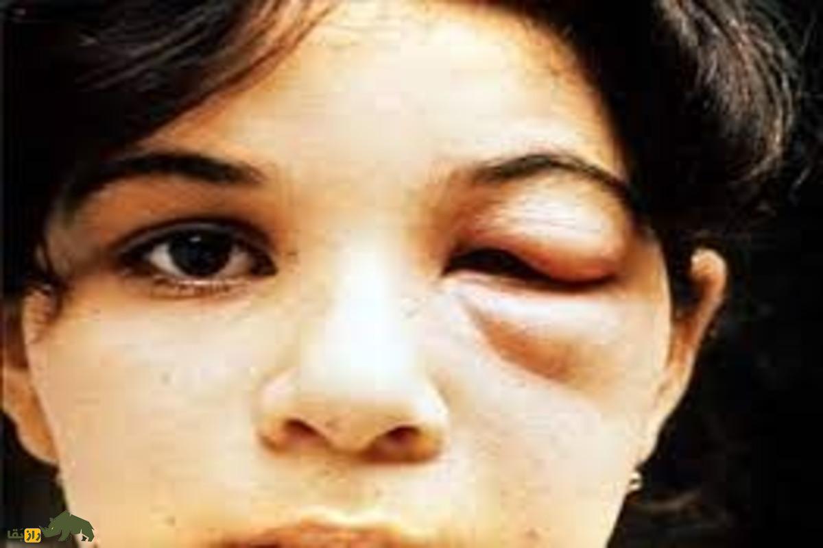 ساس‌های آدم‌کش؛ دشمنان خون‌خوار که در تاریکی شب به انسان‌ها حمله می‌کنند