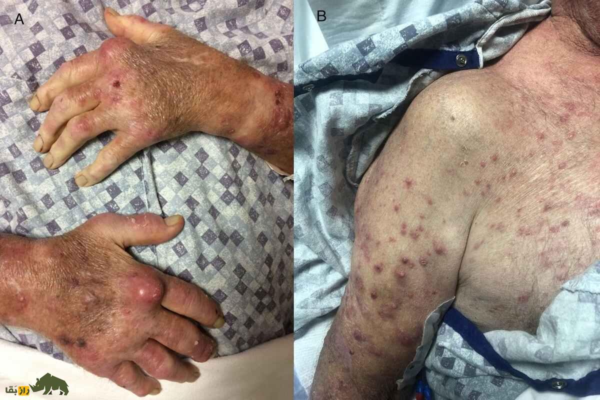 (تصاویر +۱۸) چهار کشته در فلوریدا بر اثر باکتری گوشت‌خوار؛ هشدار‌ها و وضعیت این باکتری در ایران